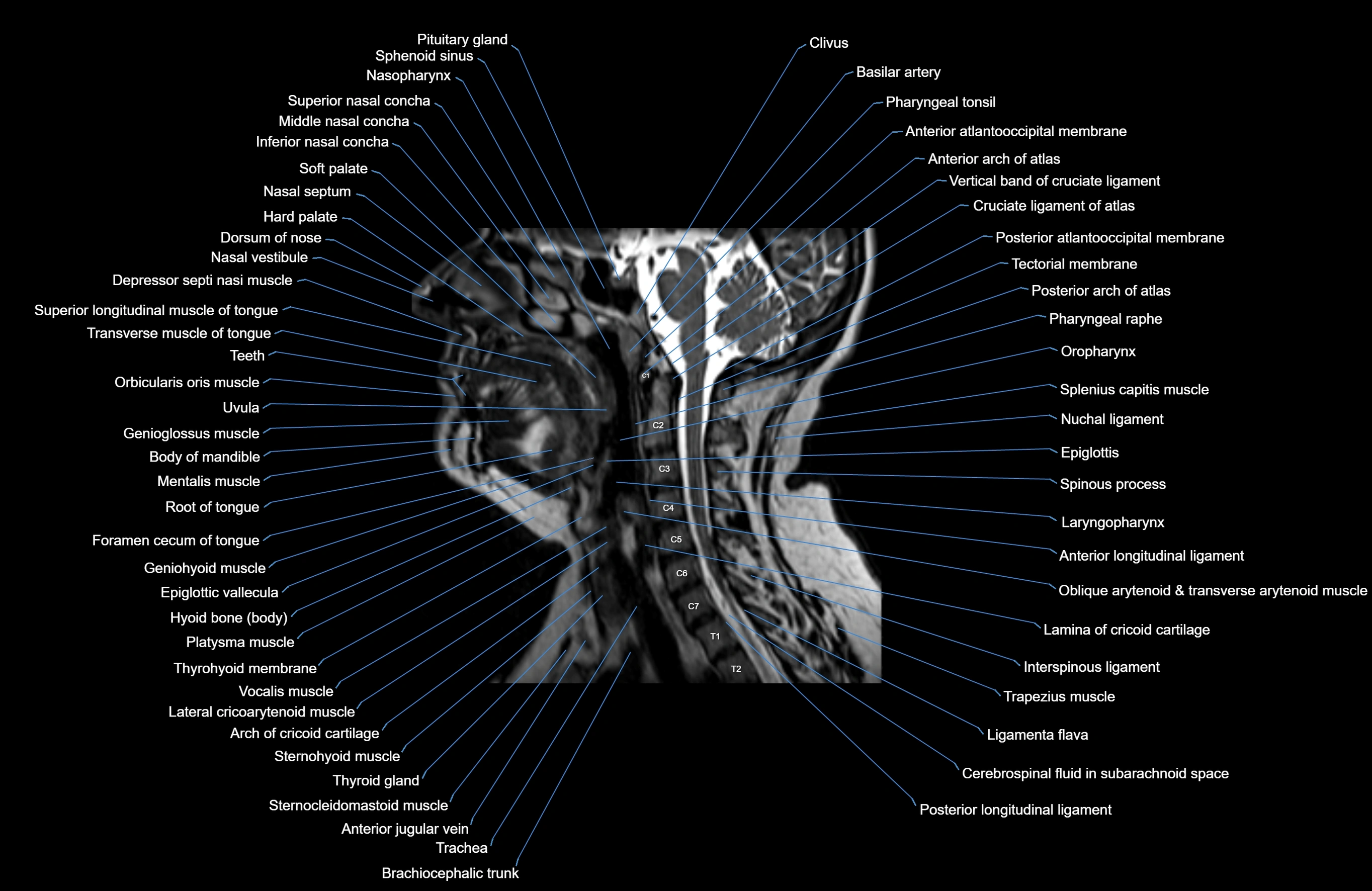 Neck MRI sagittal cross sectional anatomy 3D 1mm 3T radiology  image-img-00001-00003.webp